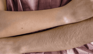 Professional lower arm hair removal treatment laser service at Sugar Fairy 
