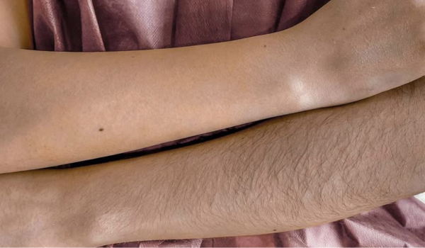 Kết quả trước và sau khi triệt lông tay bằng phương pháp Sugaring tại Sugar Fairy